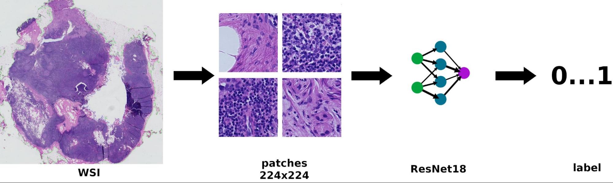 The Breast Cancer Metastasis Detection Pipeline